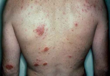 acne rashes